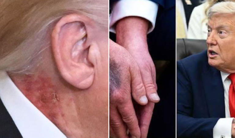 Trump’s Neck Rash Sparks Public Speculation, White House Says It’s Harmless